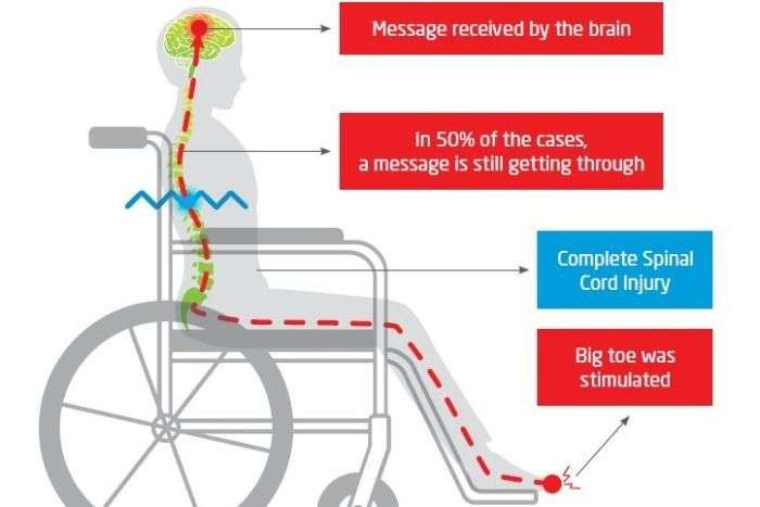 Half of spinal cord injury patients may still have some connectivity, Australian study finds