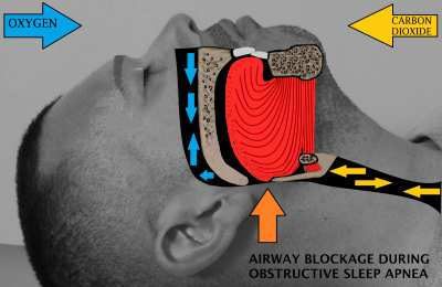 The Risk of Sleep Apnea for Quadriplegics